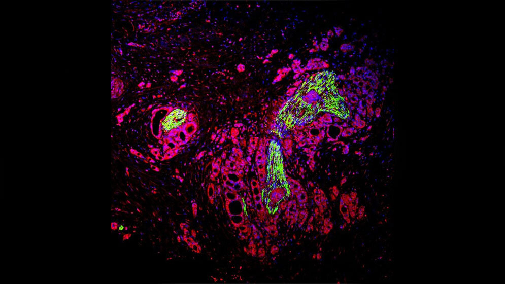 Gewebeanalyse eines am Pankreaskarzinom erkrankten Patienten