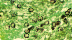 Histologische Aufnahme von einer Pneumozystose