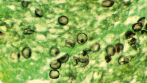 Histologische Aufnahme von einer Pneumozystose