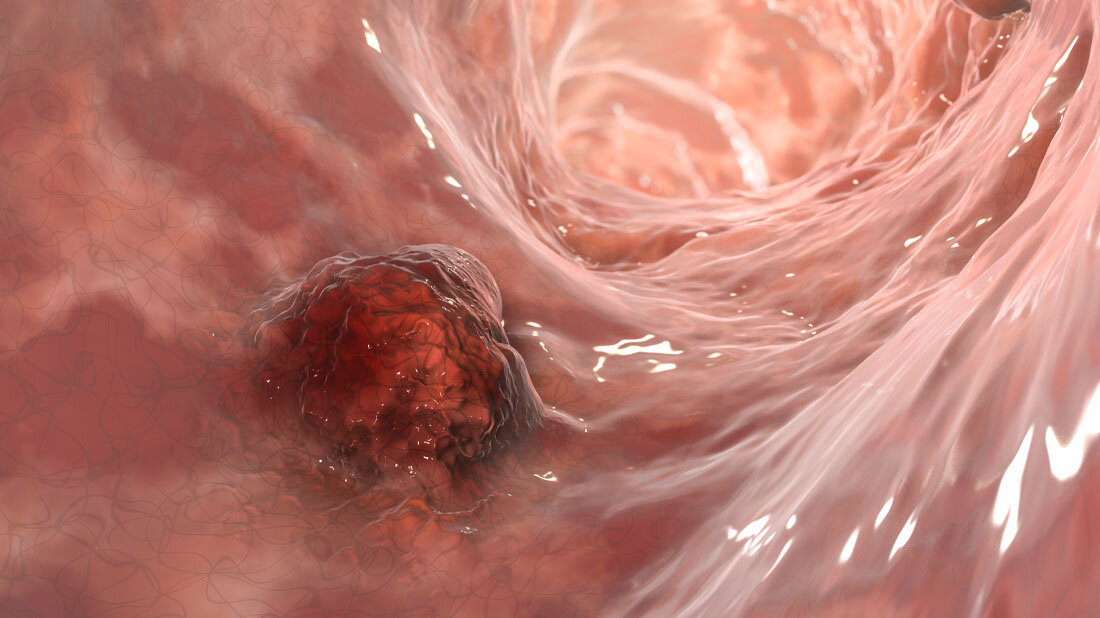 Darmkrebs_Metastasen.jpg Darmkrebs