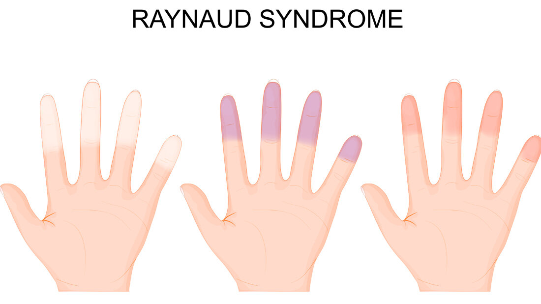 Raynaud.jpg Raynaud-Syndrom