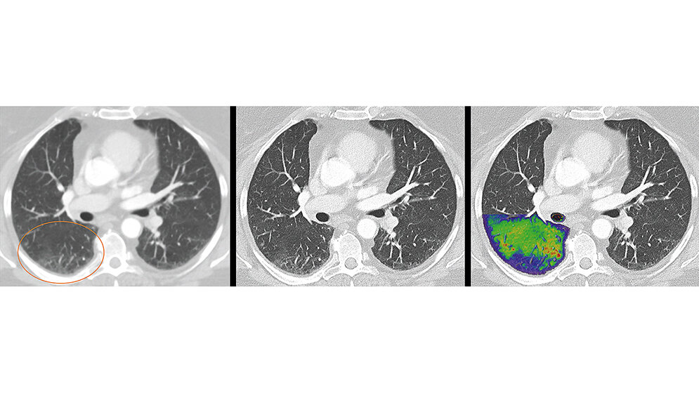 Quantenzählender Computertomograf 