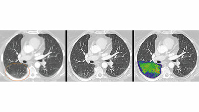 Quantenzählender Computertomograf 