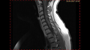 Schnittbilddiagnostik der Wirbelsäule