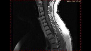 Schnittbilddiagnostik der Wirbelsäule