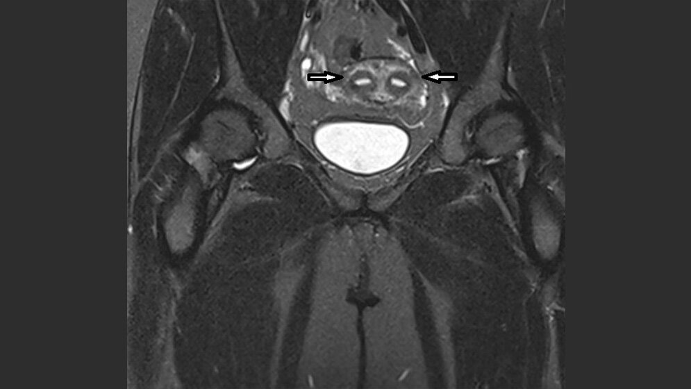 Anomalien und Normvarianten: Interne Veränderungen 2.12