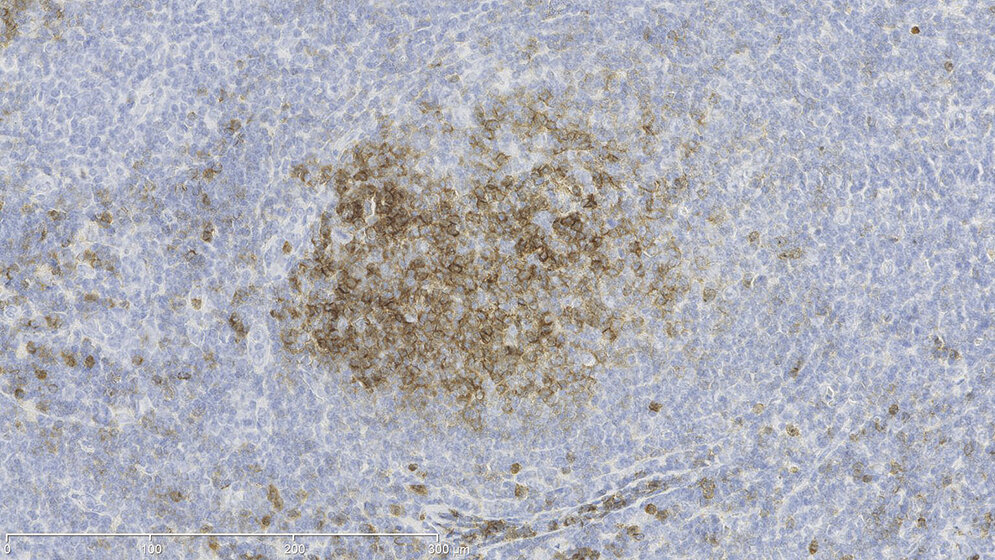 Follikuläres Lymphom