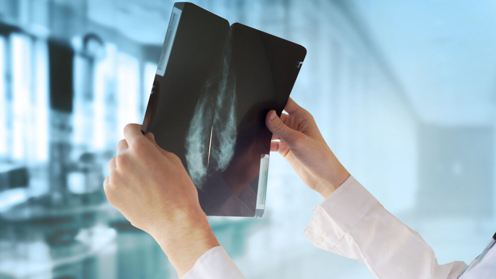 Mammographie-Screening