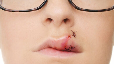 Postoperative Wundinfektionen