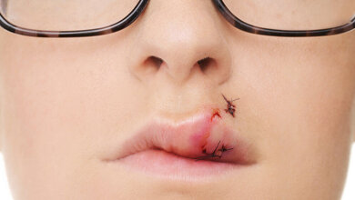 ClaireMcAdams_iStockphoto_wunde.jpg Postoperative Wundinfektionen