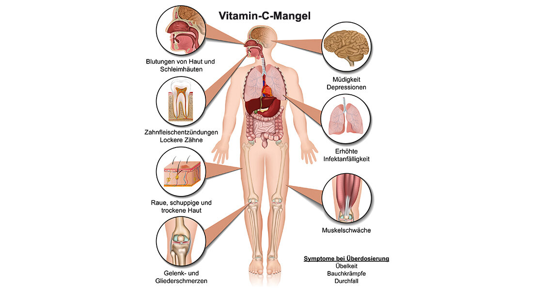 Grafik zu den Auswirkungen des Vitamin-C-Mangels