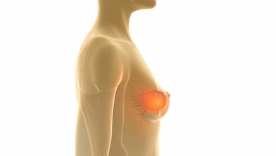 Mammakarzinome besser lokalisieren mit intraoperativen Sonografie (IOUS) 