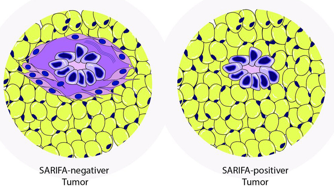 Neuer Test hilft bei Beurteilung von Magen- und Darmkrebs