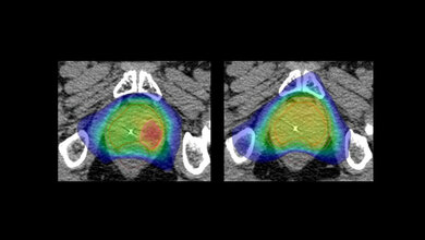Prostata.jpg Hypofocal-Studie