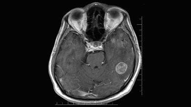 Brain_MRI.jpg Hirn-MRT