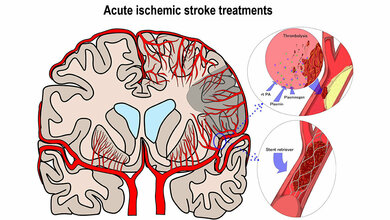 Schlaganfallmedikant Alteplase knapp, keine Alternative