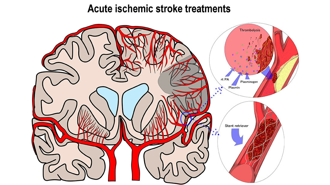 Schlaganfallmedikant Alteplase knapp, keine Alternative
