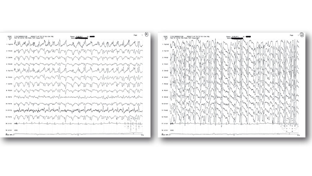 Status epilepticus (klinisch fokal) Fallbeispiel