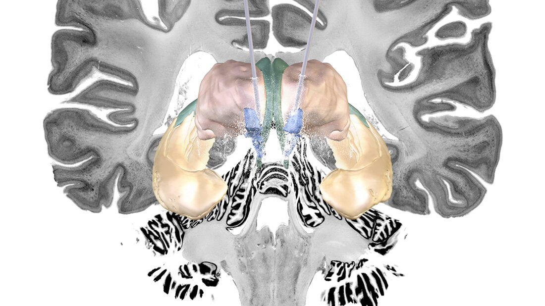 Hirnstimulation_Alzheimer.jpg Hirnschrittmacher könnte Alzheimer-Erkrankung besser behandelbar machen