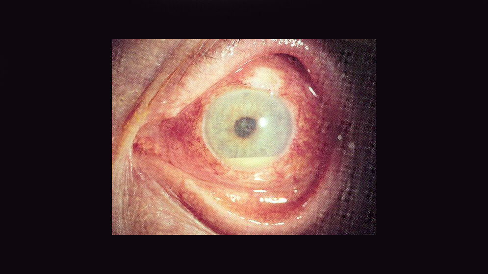 uveitis.jpg Uveitis