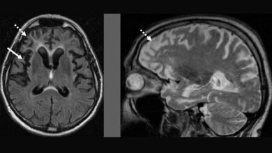 MRT eines Patienten mit Frontotemporaler Demenz