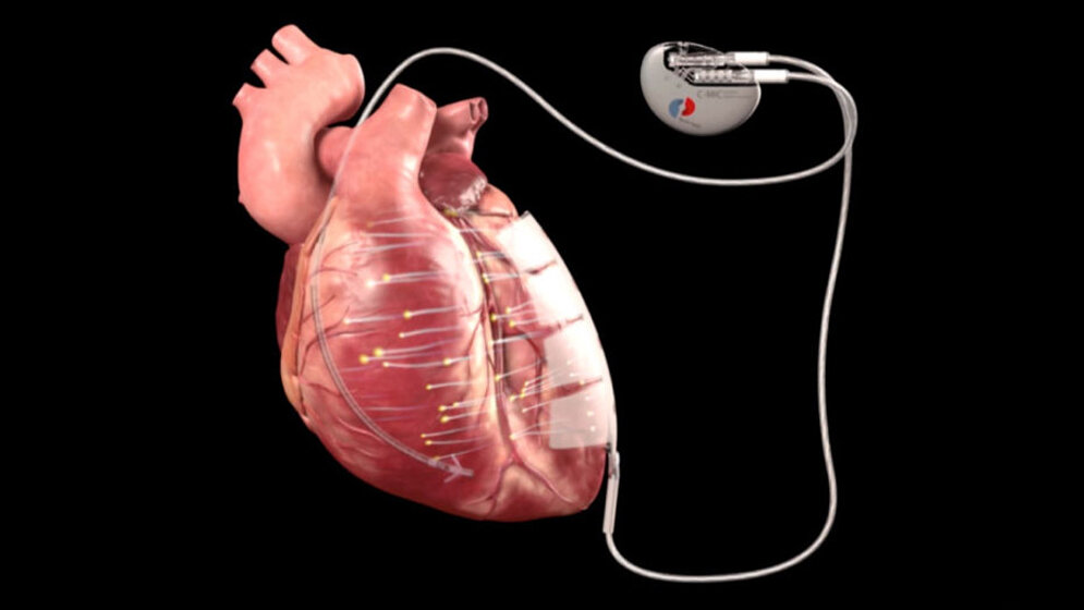 Implantierter_Impulsgeber_Berlin_Heals_GmbH.jpg Implantierter Impulsgeber