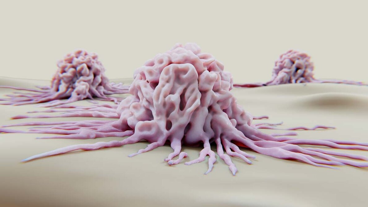 Krebs_AdobeStock_456005144_edited.jpg Krebszellen