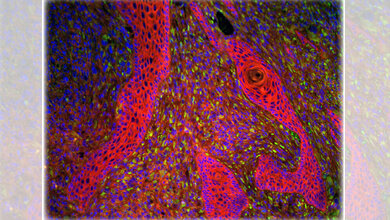 Plattenepithelkarzinom