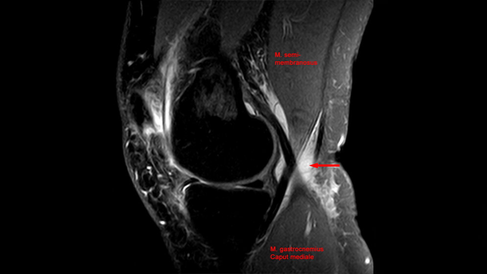 Baker-Zyste in der MRT 