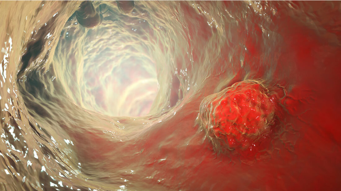 Darmkrebs
