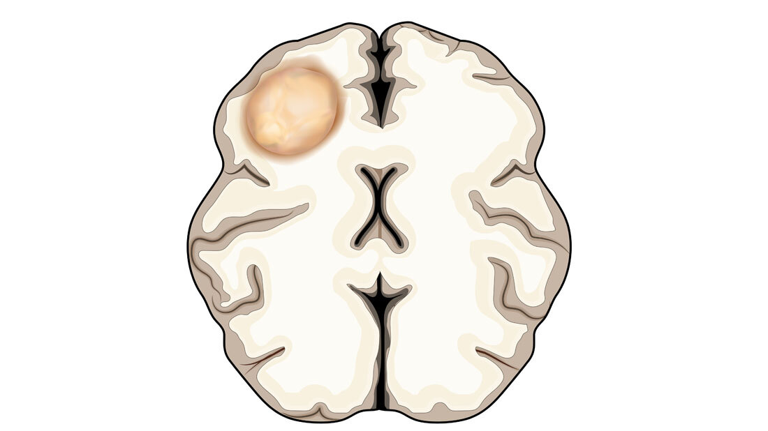 Symbolbild eines Glioblastoms.