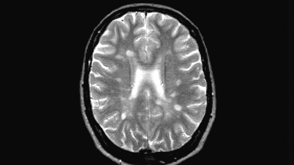 Multiple Sklerose: Gehirn mit typischen MS-Plaques