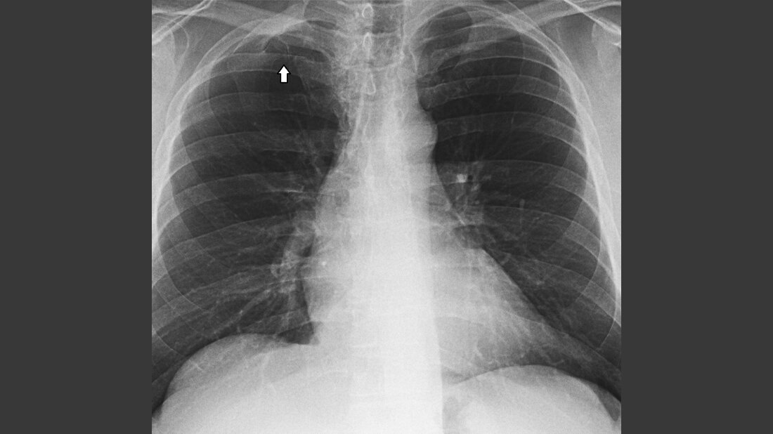 Röntgen Thorax: Srb’sche Anomalie