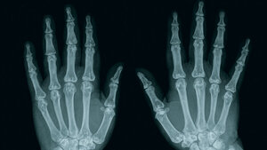 Osteopoikilie