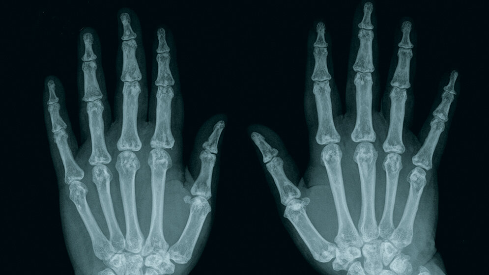Anomalien und Normvarianten Osteopoikilie