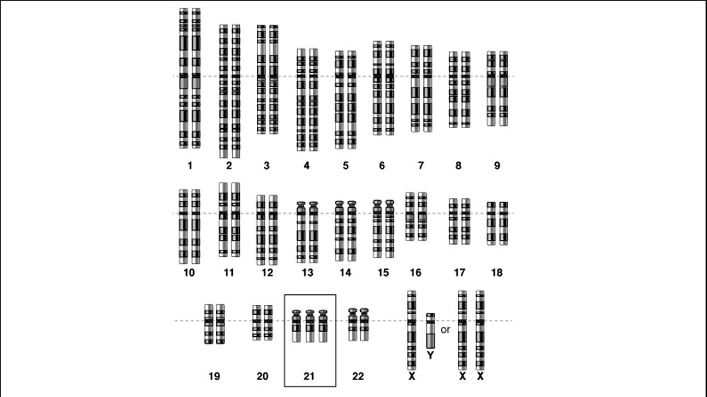 Schema des Genoms bei freier Trisomie 21