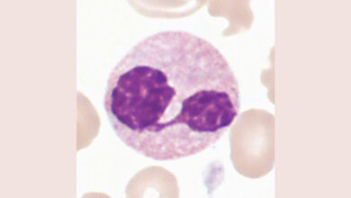 Dysplastische Veränderungen der Hämatopoese (Teil 2)