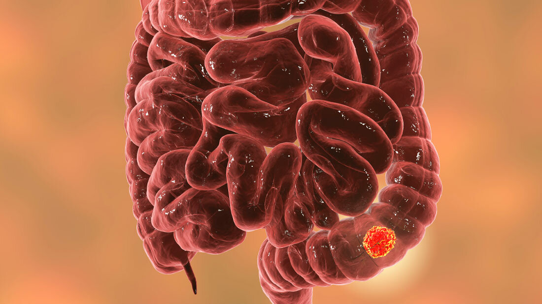Darmkrebs