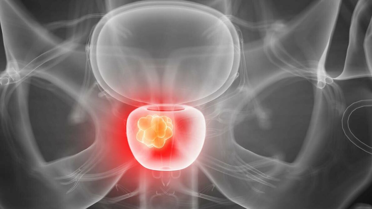 Prostata_AdobeStock_221181904_edited.jpg Prostatakrebs