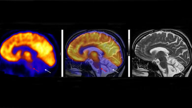 Stoffwechselaktivität des Gehirns