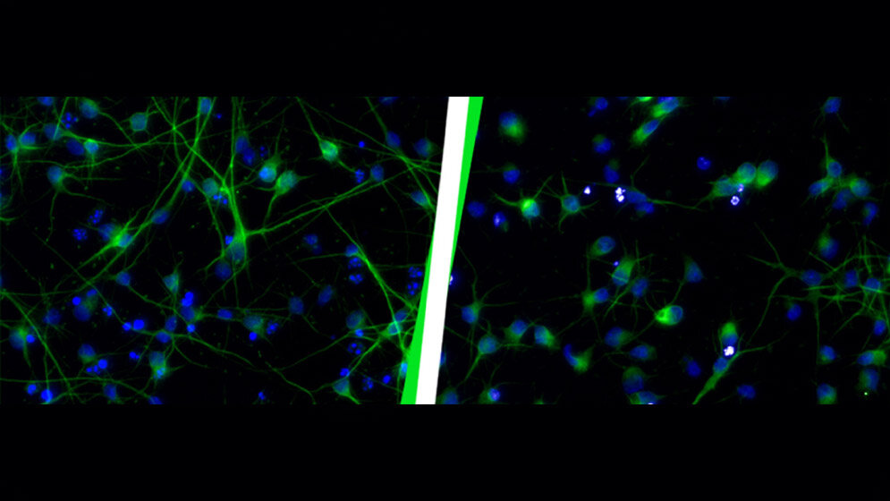 Gesunde Neuronen (links) im Vergleich zu Neuronen nach einer Aktivierung von HERV-K(HML-2) (rechts).
