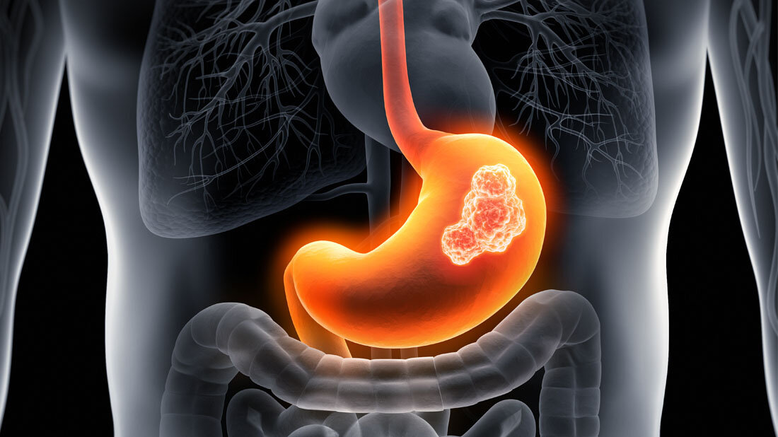 Das Magenkarzinom ist die fünfthäufigste Krebserkrankung weltweit. In Deutschland erkranken laut Krebsinformationsdienst jährlich etwa 15.000 Menschen daran. 