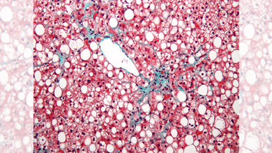 NAFLD_Nephron_own_work_CC_BY_SA_3_0_wikimedia.jpg NAFLD