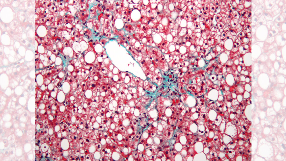 NAFLD_Nephron_own_work_CC_BY_SA_3_0_wikimedia.jpg NAFLD