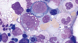 Mikroskopisches Präparat mit charakteristischen zytoplasmatischen Vakuolen bei VEXAS-Syndrom im Knochenmarksausstrich