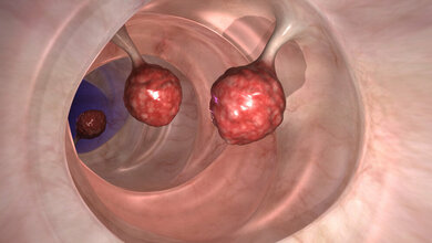 Wie wirksam sind Vorsorge-Darmspiegelungen in Deutschland?