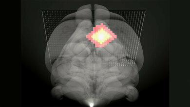 neue MRT Methode bei Ischämie