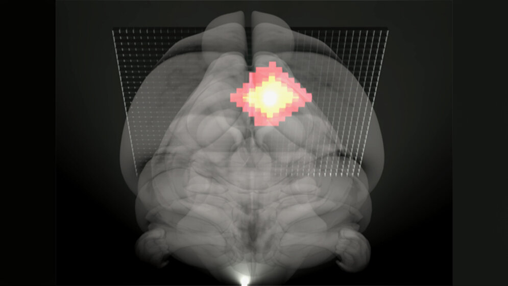 neue MRT Methode bei Ischämie