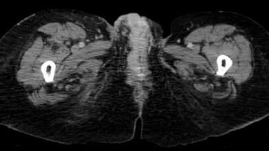 Vulvakarzinom in der CT