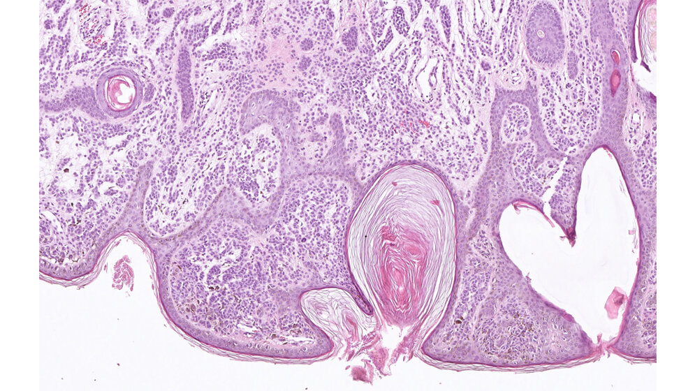 Histopathologisches Präparat eines gutartigen Muttermals 